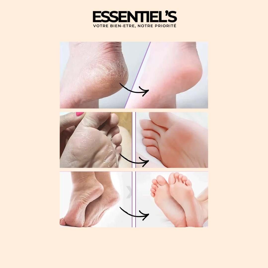 FOOT PEEL MASK™ - Retrouvez maintenant vos jolis pieds de bébé !