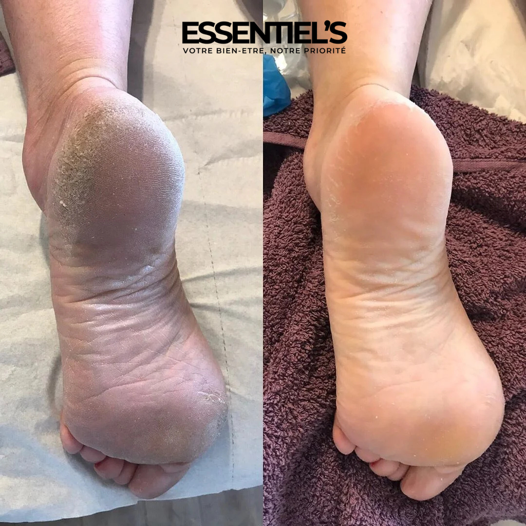 FOOT PEEL MASK™  - Retrouvez vos jolis pieds de bébé en 5 jours !