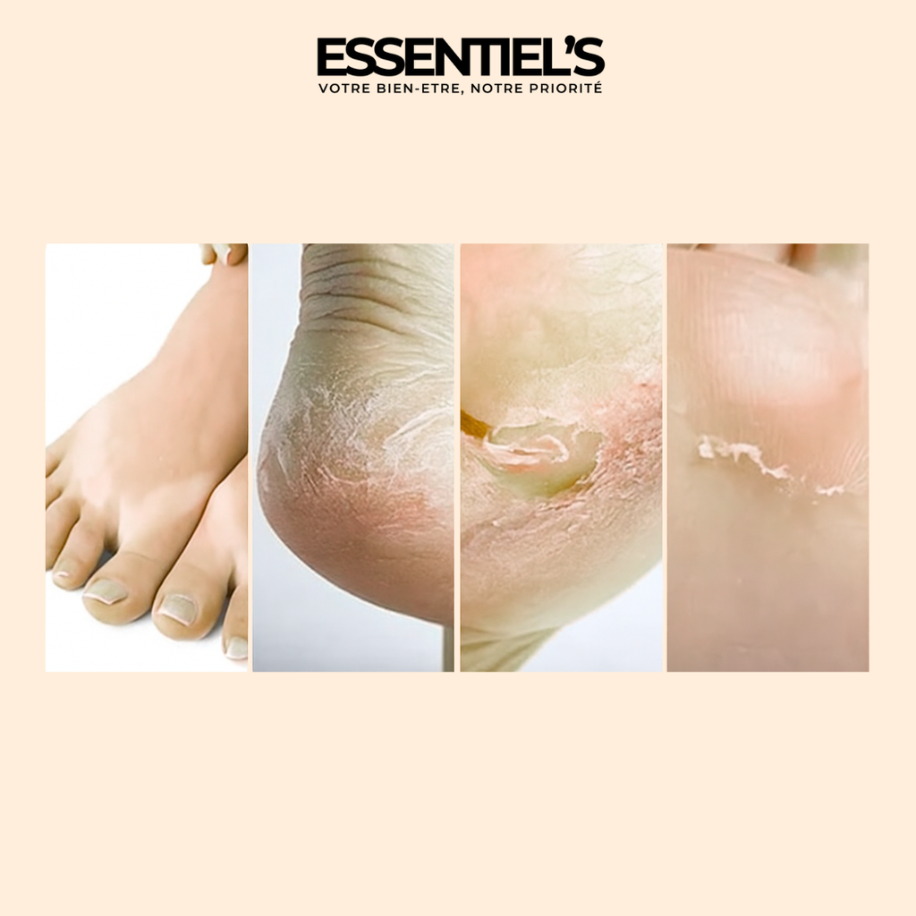 FOOT PEEL MASK™  - Retrouvez vos jolis pieds de bébé en 5 jours !