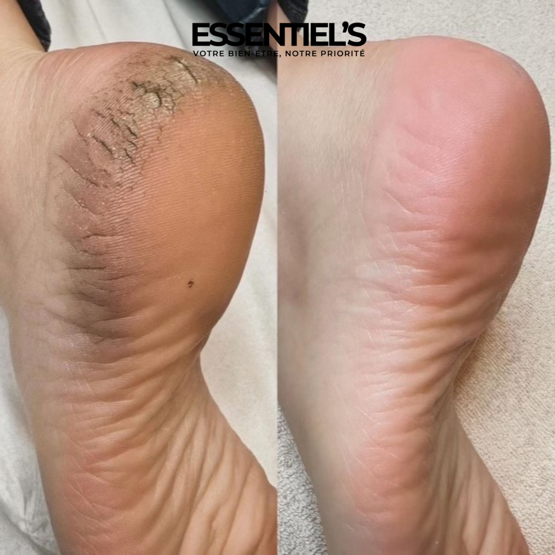 FOOT PEEL MASK™  - Retrouvez vos jolis pieds de bébé en 5 jours !